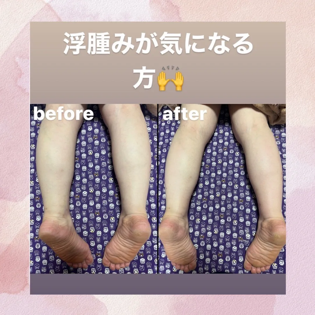 むくみでお悩みの方